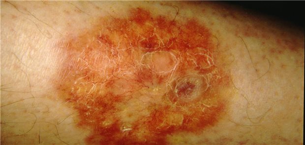 Die Therapie einer Necrobiosis lipoidica gestaltet sich schwierig. Eine S1-Leitlinie kann hier nun Ärzten und Ärztinnen helfen. (Symbolbild)