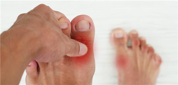 Fuß eines Patienten mit Gicht. 