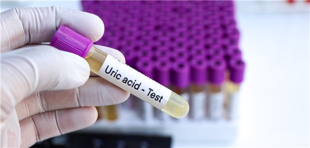 Urinprobe für Harnsäuretests im Labor zur Feststellung von Anomalien im Urin.