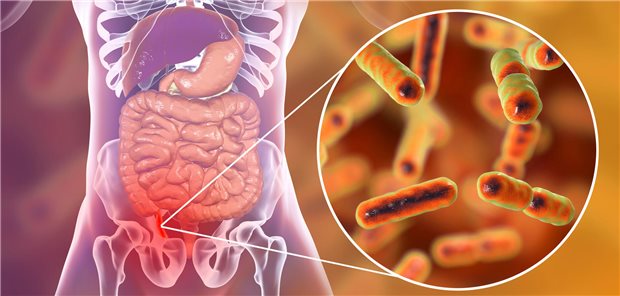 Die Ursache der Appendizitis des jungen Mannes war offenbar eine Aktinomykose, ausgelöst durch Actinomyces israelii, ein gram-positives anaerobes Bakterium, das als Kommensale in der Mundhöhle und auch im Gastrointestinaltrakt vorkommt.