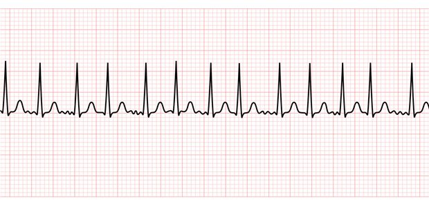 Die Wahrscheinlichkeit, VHF-Trigger außerhalb des Pulmonalvenensystems zu finden, beträgt 5,9 Prozent bei einem PRE2SSS2-Score von 0–1, 19,2 Prozent bei einem Score von 2–4 und 40,0 Prozent bei einem Score von 5–6.