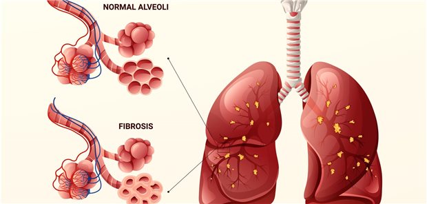 Die Wissenschaftler um Chanho Lee resümieren, dass Ezetimib unabhängig vom Antifibrotikum Perfenidon zu einer Verbesserung des Outcomes bei IPF-Patienten beitragen könne. Dies gelte umso mehr, als die mit Ezetimib co-therapierten Patienten auch bei der Lungenfunktion besser abschnitten als jene, die nur Perfenidon erhalten hatten.