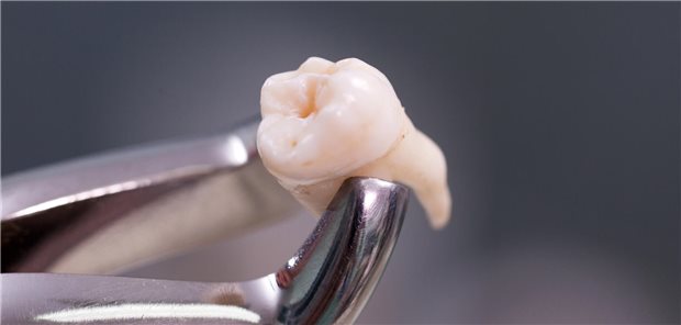 Die Zahnextraktion nach der Bestrahlung ist zwar möglich - für die klinische Routine eignet sie sich aber nicht.