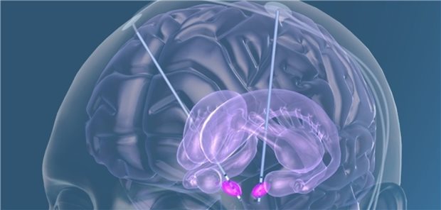 Die Zielregion für eine Tiefe Hirnstimulation bei M. Parkinson liegt meist im Nucleus subthalamicus.