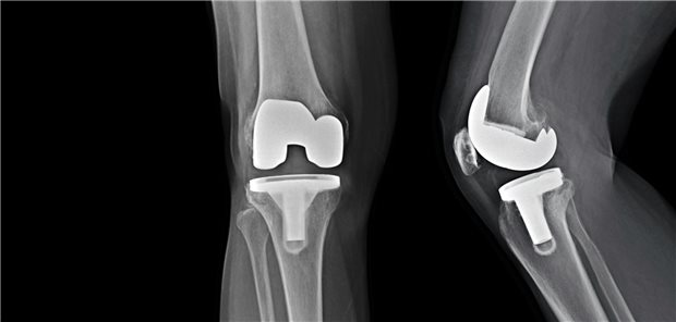 Röntgenaufnahme Knie mit Knieendoprothese