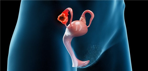 Die abdominale retroperitoneale Lymphadenektomie zur Komplettierung der zytoreduktiven Chirurgie bei fortgeschrittenem Ovarialkarzinom ohne verdächtige Lymphknoten bietet nach den Studie LION und CARACO keinen Vorteil, egal, ob sie im Rahmen einer primären Operation oder Intervall-Operation nach neoadjuvanter Therapie erfolgt. 