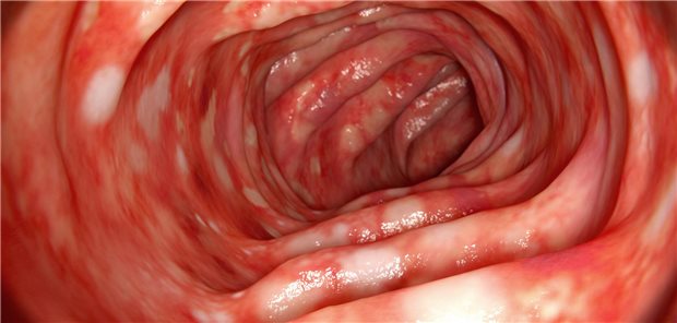 Die aktualisierte Colitis-ulcerosa-Leitlinie enthält Informationen über die neuen Wirkstoffe Upadacitinib und Mirikizumab.
