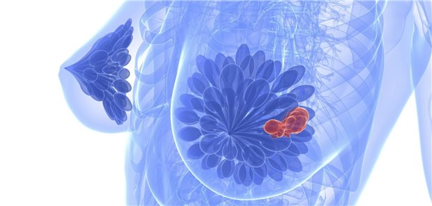 Hohe Brustkrebs-Prävalenz im hohen Norden Die altersstandardisierte Diagnoseprävalenz von Brustkrebs lag 2019 im Bundesschnitt bei 2,31 Prozent.