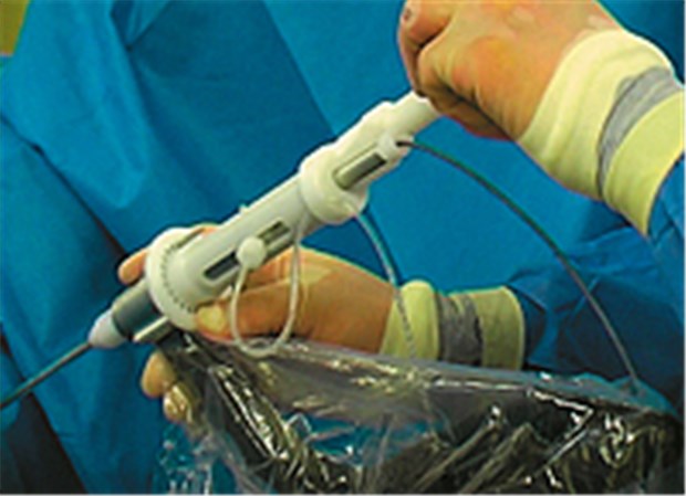 Tissue Engineering gegen Stressinkontinenz Die aufbereiteten Muskelzellen werden mit einer Sonde in den Rhabdosphinkter der Harnröhre gespritzt. © Innovacell
