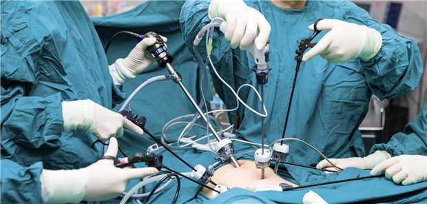 Eine Aufnahme von vier Chirurgen während einer laparoskopischen Bauchoperation im Operationssaal.