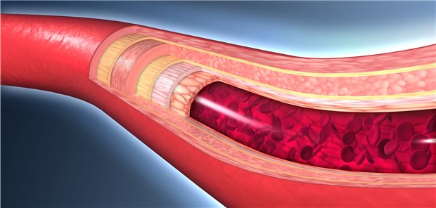 „COVID-19 ist auch eine systemische Gefäßentzündung“ Die durch SARS-CoV-2 ausgelöste Endotheliitis führt zu schweren Mikrozirkulationsstörungen, die unter anderem das Herz schädigen.
