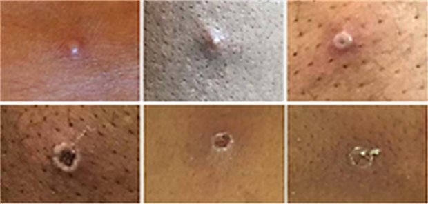 Affenpocken-Symptome im Detail: Wie die Hautveränderungen aussehen können Affenpocken-Symptome im Detail: Wie die Hautveränderungen aussehen können