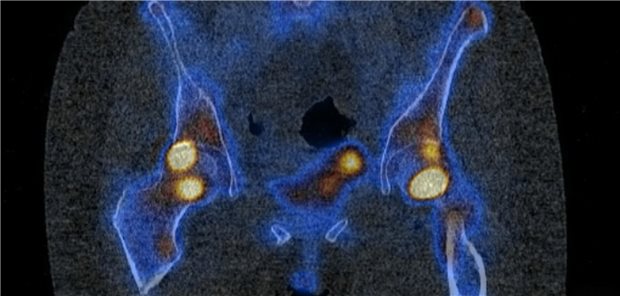 Skelettszintigraphie einer betroffenen Patientin mit Osteomalazie in den Hüften (gelb) nach intravenöser Eisentherapie mit Eisencarboxymaltose.