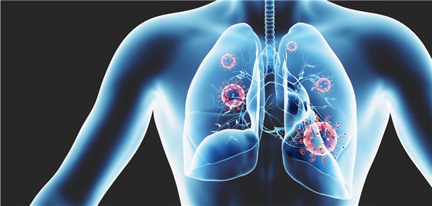 Die guten Erfahrungen mit der CRP-Apherese bei schwerer COVID-19-Pneumonie werden derzeit in einer randomisierten kontrollierten Studie überprüft.