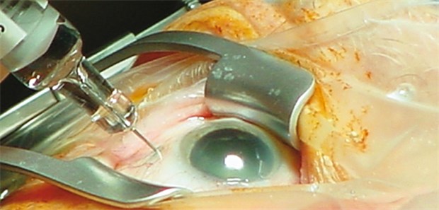 Die intravitreale Injektion zieht seit kurzem nicht mehr die Streichung des lohnenden Zuschlags nach EBM-Ziffer 06225 nach sich. Ansonsten aber sollten konservativ tätige Augenärzte den K.O.-Katalog im Blick behalten.