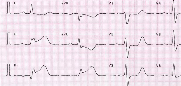 Die jährlichen Inzidenzraten bestätigen den Trend der Registerdaten, sowohl für die Gesamtmortalität als auch für den kardiovaskulären Tod und die MACE-Rate (nichttödlicher Herzinfarkt, nichttödlicher Schlaganfall oder Hospitalisierung aufgrund von Herzinsuffizienz). In allen drei Kategorien ließ sich ein signifikanter Rückgang bei Personen mit Typ-2-Diabetes beobachten (um 2,2 Prozent, 2,4 Prozent und 4,0 Prozent), nicht aber für Menschen mit Typ-1-Diabetes.