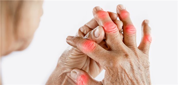Frau, die an Gelenkschmerzen aufgrund einer Calciumpyrophosphat-Dihydrat-Arthritisim Finger leidet.