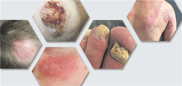 verschiedene Darstellungen von Hautpilzerkrankungen