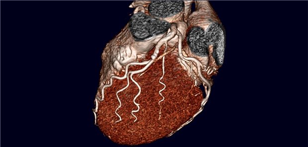 Die koronare CT-Angiografie ist eine von mehreren Optionen der Diagnostik bei KHK-Verdacht.