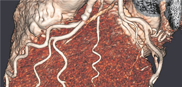 Die koronare CT-Angiografie ist insbesondere in Großbritannien in den Praxisleitlinien weit nach vorn gerückt.