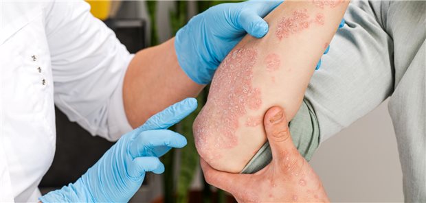 Psoriasis: Unterschiedliches Infektionsrisiko unter Biologika Eine Dermatologin untersucht die Haut eines Patienten mit Psoriasis mit behandschuten Händen.