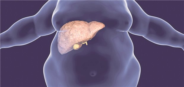 Die metabolisch assoziierte Fettlebererkrankung (MASLD) ist die weltweit häufigste chronische Lebererkrankung mit einer geschätzten globalen Prävalenz von 38 Prozent. Die MASLD wird häufig als hepatische Manifestation des metabolischen Syndroms angesehen und ist eng mit Adipositas und Typ-2-Diabetes (T2D) assoziiert.