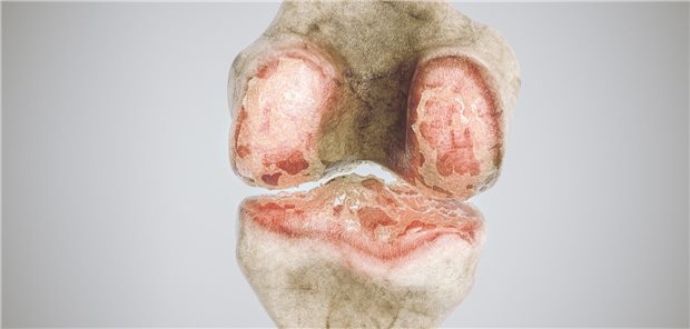 Dreidimensionale gerenderte Darstellung einer fortgeschrittene Arthrose am Kniegelenk.