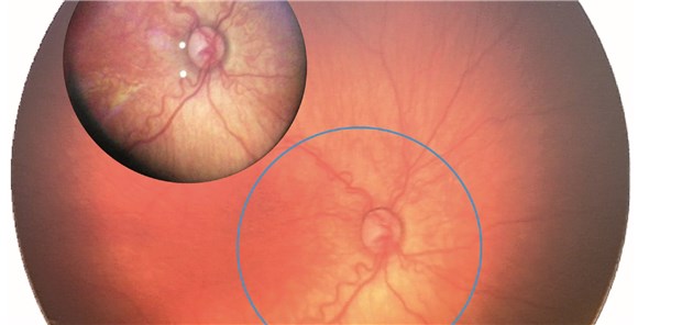Retinopathie-Diagnostik bei Frühchen via Smartphone Die mittels Smartphone erstellten Bilder (kleiner Kreis) sind Aufnahmen mit herkömmlichen Geräten in Bezug auf die Bildqualität mindestens ebenbürtig. Allerdings muss eine höhere Anzahl von Fotos gemacht werden, um die gesamte Netzhaut abzubilden.