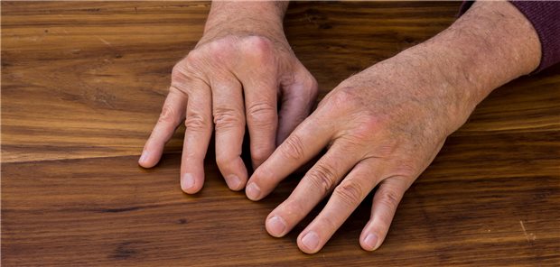 Die nach 16 Wochen beobachtete Wirksamkeit der Studie BE COMPLETE blieb in der Verlängerungsstudie BE VITAL erhalten. So hatten nach 52 Wochen 51,7 Prozent der von vornherein mit Bimekizumab Behandelten und 40,6 Prozent der zu Beginn der offenen Studienphase von Placebo auf Verum Gewechselten eine mindestens 50-prozentige Verbesserung bei den Aktivitätskriterien des American College of Rheumatology (ACR).