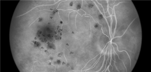 Die nach einem Jahr erzielten Verbesserungen beim Visus und den Netzhautbefunden konnten aufrechterhalten werden. Der Zugewinn an bestkorrigierter Sehschärfe war mit beiden Medikamenten ähnlich: Durchschnittlich 3,7 und fünf Buchstaben mehr als zu Studienbeginn konnten mit Faricimab Behandelte nach zwei Jahren erkennen, während es unter Aflibercept 3,3 und 5,2 waren.