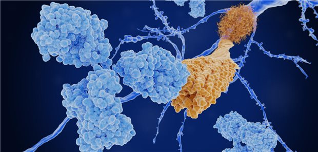 Amyloid-Ablagerungen an Neuronen.