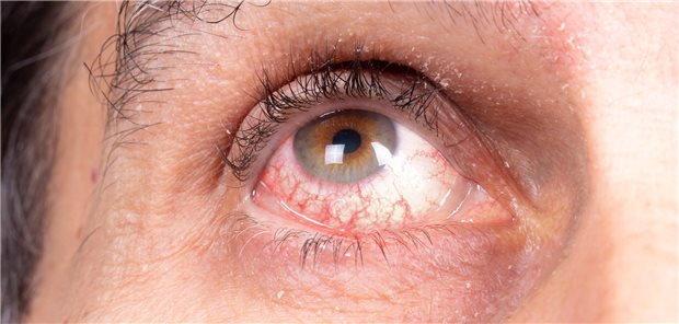 Die nichtinfektiöse Uveitis ist eine Hauptursache von Sehbehinderungen. Am häufigsten ist die anteriore Form, die oft gut auf topische GC anspricht. Entzündungen, die sich nicht auf den vorderen Augenabschnitt beschränken, bedürfen oft einer systemischen oder intravitrealen GC-Therapie.