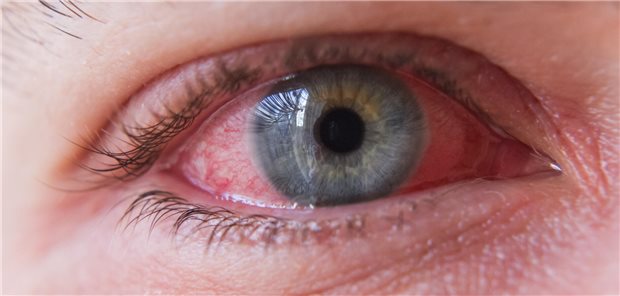 Makro-Nahaufnahme eines Auges mit okulärer Rosazea.