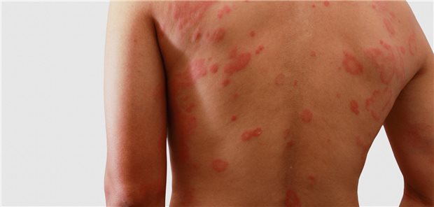 Rücken eines Mannes mit Radiodermatitis.