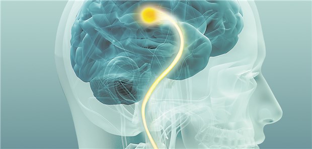Mit Elektrostimulation bildet sich die Dysphagie zurück Die pharyngeale elektrische Stimulation (PES) aktiviert bei Dysphagie die sensiblen Leitungsbahnen (gelb), die das Schlucken steuern.