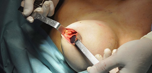 Ärzte haften nicht für PIP Die qualitativ mangelhaften Brust-Implantate des französischen Anbieters PIP sorgten im vergangenen Jahr auch in Deutschland für eine Reihe von Op zur Explantation eines Silikonimplantats aus der Brust.