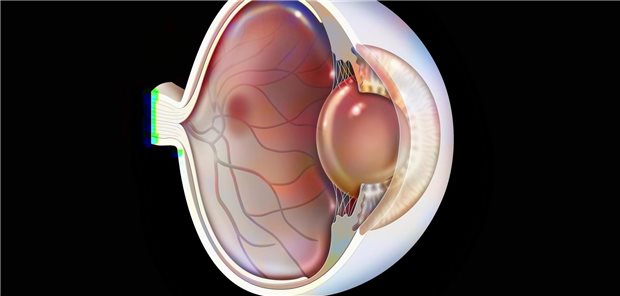 Dreidimensionale Darstellung der neovaskulären altersbedingten Makuladegeneration (degenerative Erkrankung der Netzhaut des Auge).