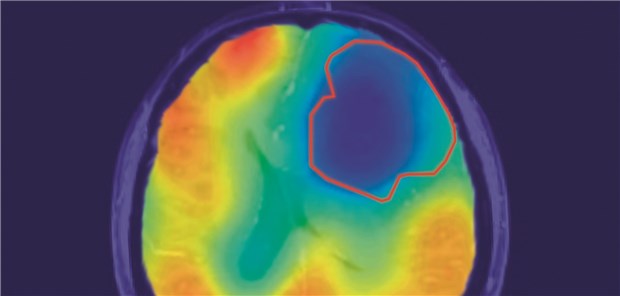 Wie Sauerstoff Hirntumoren sichtbar macht Die rote Linie markiert das Tumorareal. Der farbige Kontrast zeigt den Sauerstoff-Stoffwechsel an. Wie vom Warburg-Theorem vorhergesagt, ist der Sauerstoff-Umsatz im Tumor reduziert (blau).
