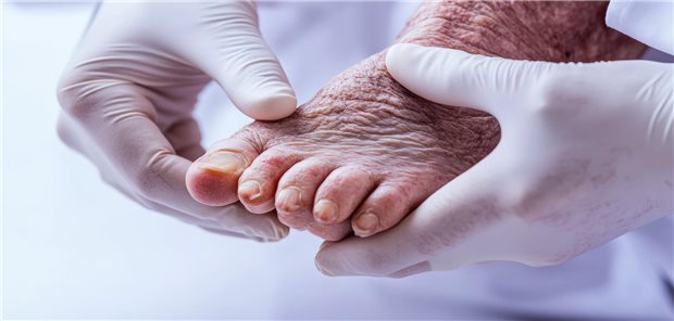 Die sorgfältige Fußhygiene ist für Diabetiker unerlässlich, um das Risiko der gefürchteten Fußkomplikationen zu senken. Dabei scheinen Chlorhexidin-Tücher jedoch nicht effektiver zu sein als Feuchttücher, so ein US-amerikanisches Team.