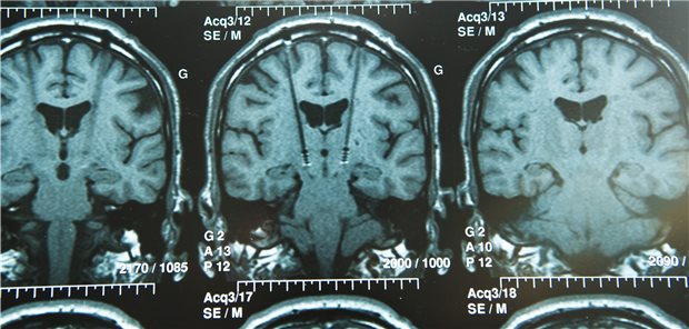 Tiefe Hirnstimulation bei Parkinson besser als Schein-Stimulation Die stereotaktische Implantation von Elektroden für die tiefe Hirnstimulation ist eine etablierte Behandlung von Parkinson-Patienten.