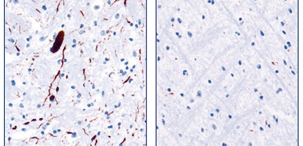 Neuer Ansatz gegen Parkinson, CJK und Alzheimer Die therapeutische Wirksamkeit von Anle138b konnte unter anderem in transgenen Parkinson-Mäusen nachgewiesen werden: In ihrem Hirngewebe finden sich pathologische -Synuclein-Ablagerungen (braun gefärbte Flecken im li. Bild). In Mäusen, die Anle138b mit dem Futter verabreicht bekamen, bilden sich deutlich weniger Ablagerungen (re. Bild).