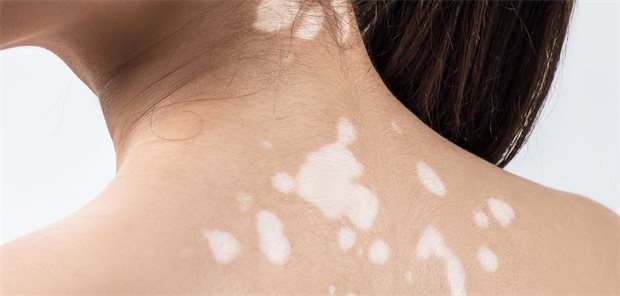 Eine Frau mit segmentalen Vitiligo-Flecken auf dem Rücken.
