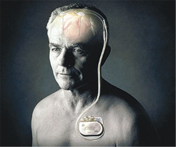 Fortschritte bei der tiefen Hirnstimulation Die tiefe Hirnstimulation ist eine Option, wenn die Symptome trotz Medikation persistieren.