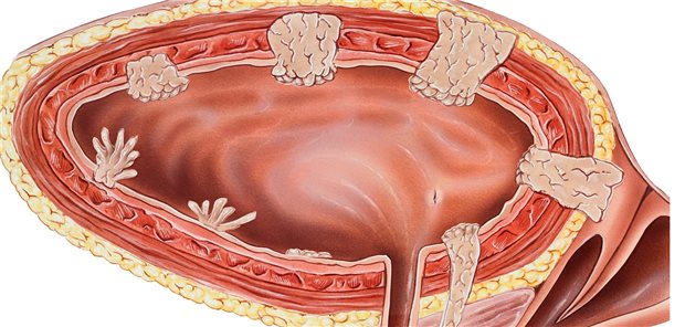 Die verschiedenen Stadien von Harnblasenkrebs