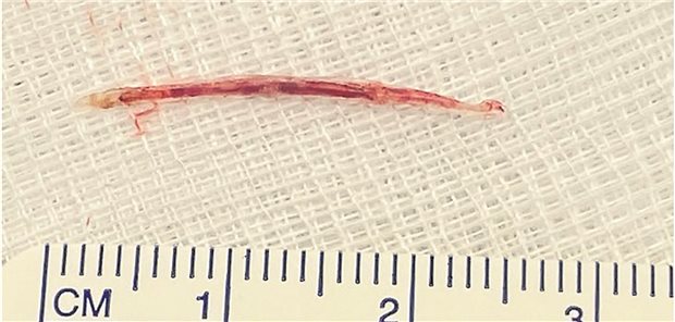 Die Fischgräte war 2,6 cm lang (Bildausschnitt Figure 3A).