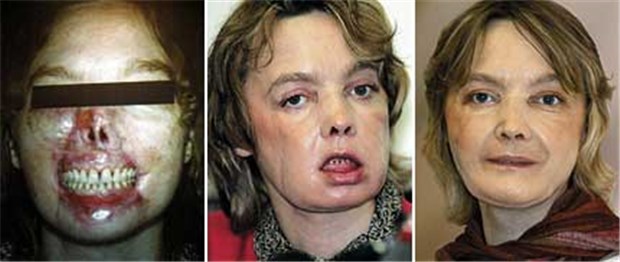 Ein transplantiertes Gesicht bedeutet einen ständigen Kampf gegen Abstoßungsreaktionen Die weltweit erste Gesichtstransplantation ist bisher ein Erfolg: Die Französin Isabelle Dinoire nach Amputation großer Gesichtsteile (links) sowie drei Monate (Mitte) und ein Jahr nach der Operation.