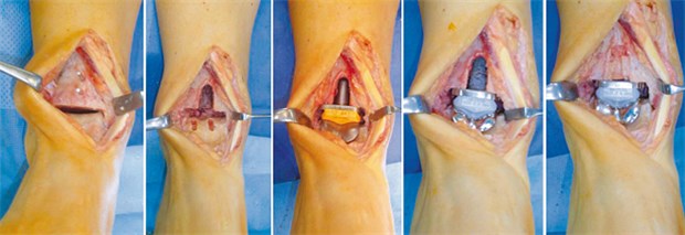 Endoprothese im Sprunggelenk - das geht gut Die zementfreie Implantation einer Endoprothese mit mobilem Gleitkern bei fortgeschrittener Sprunggelenkarthrose hat sich bewährt.
