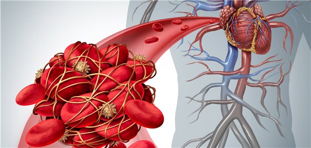 Die zusätzliche Einnahme von Colchicin wirkt bei KHK-Patienten auf kombinierte sowie auch einzelne kardiovaskuläre Endpunkte.