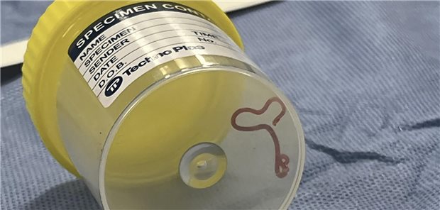 Wurm in Gehirn von Australierin entdeckt Dieser lebendige, acht Zentimeter lange Rundwurm in einem Plastikbecher.