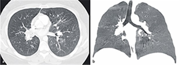Husten mit Auswurf: Folge eines M. Crohn? Diffuse bronchiolitische Veränderungen (a) und subtotaler Verschluss des rechten Hauptbronchus (b): Befunde bei pulmonalem Morbus Crohn.